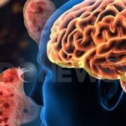 Steps Taken to Save Athletes From Brain-Eating Amoeba in Swimming Pools