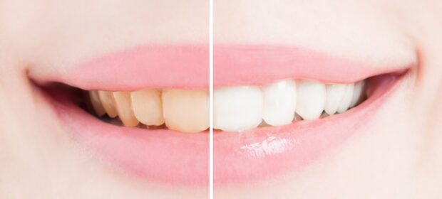 6 Natural Herbs That Help Whiten Teeth