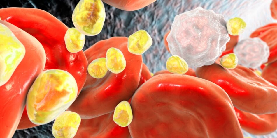 Uncommon Signs of High Cholesterol in Your Hands